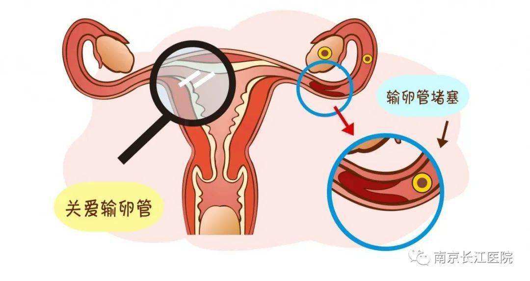 「输卵管堵塞怎么办」检查输卵管堵塞怎么办