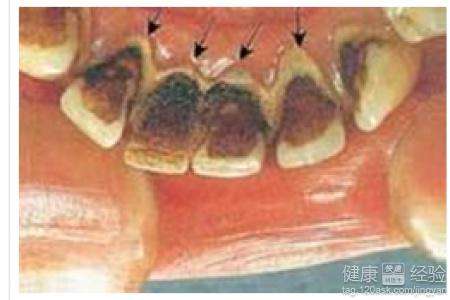 「牙结石怎么办」牙结石怎么办?如何去除牙结石呢?