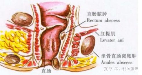 「肛瘘怎么办」孕妇肛瘘怎么办